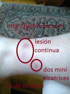 cicatriz tratada con aceite de rosa mosqueta, día cero