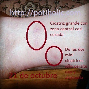 aceite de rosa mosqueta para tratar cicatrices dia 9