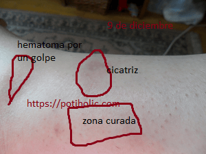 cicatriz tratada con aceite de rosa mosqueta, al cabo de dos meses