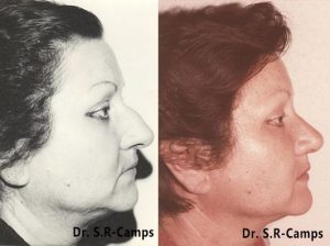 rinoplastia en Valencia antes y despues