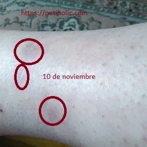 rosa mosqueta para cicatrices, evolución tras un mes de tratamiento en cicatriz no quirúrgica